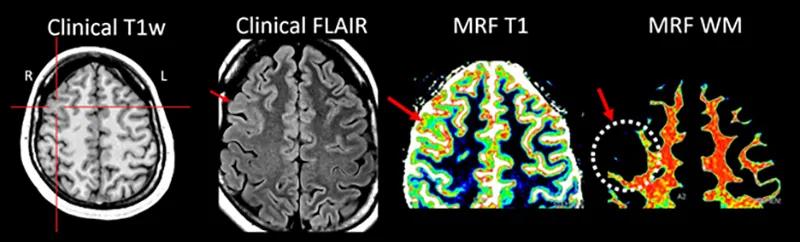 four brain scans arranged horizontally with text labels above them