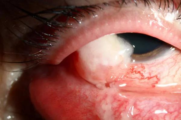 Eye