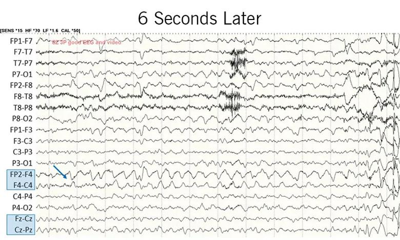 EEG recording