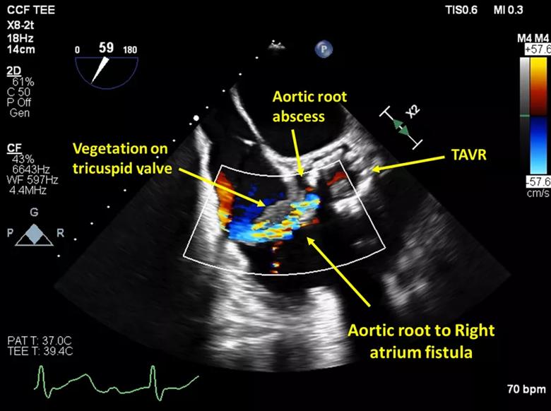 echocardiogram showing endocarditis involving TAVR prosthesis