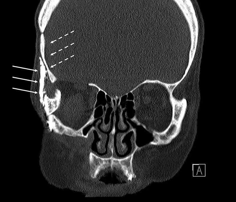 brain scan with arrows pointing to structures on the left side