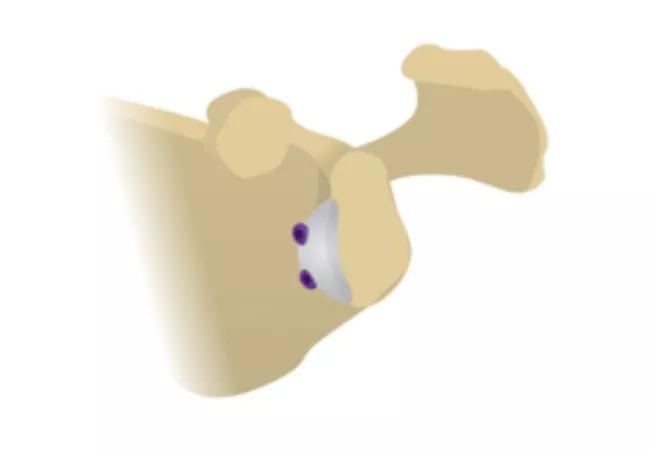 Placement and fixation of the Glenojet graft
