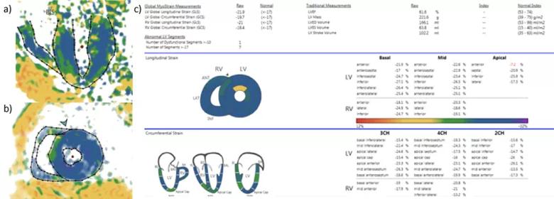 fast strain-encoded CMR imaging