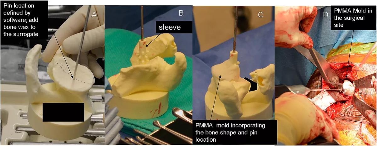 Shoulder surgery