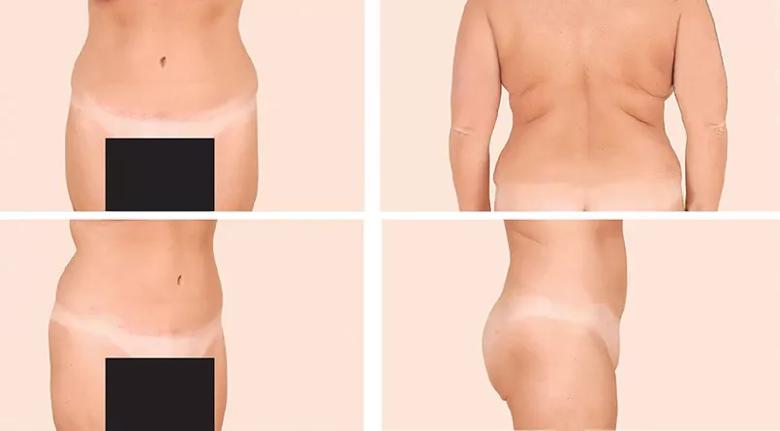 Cosmetic and Noncosmetic Indications for Liposuction