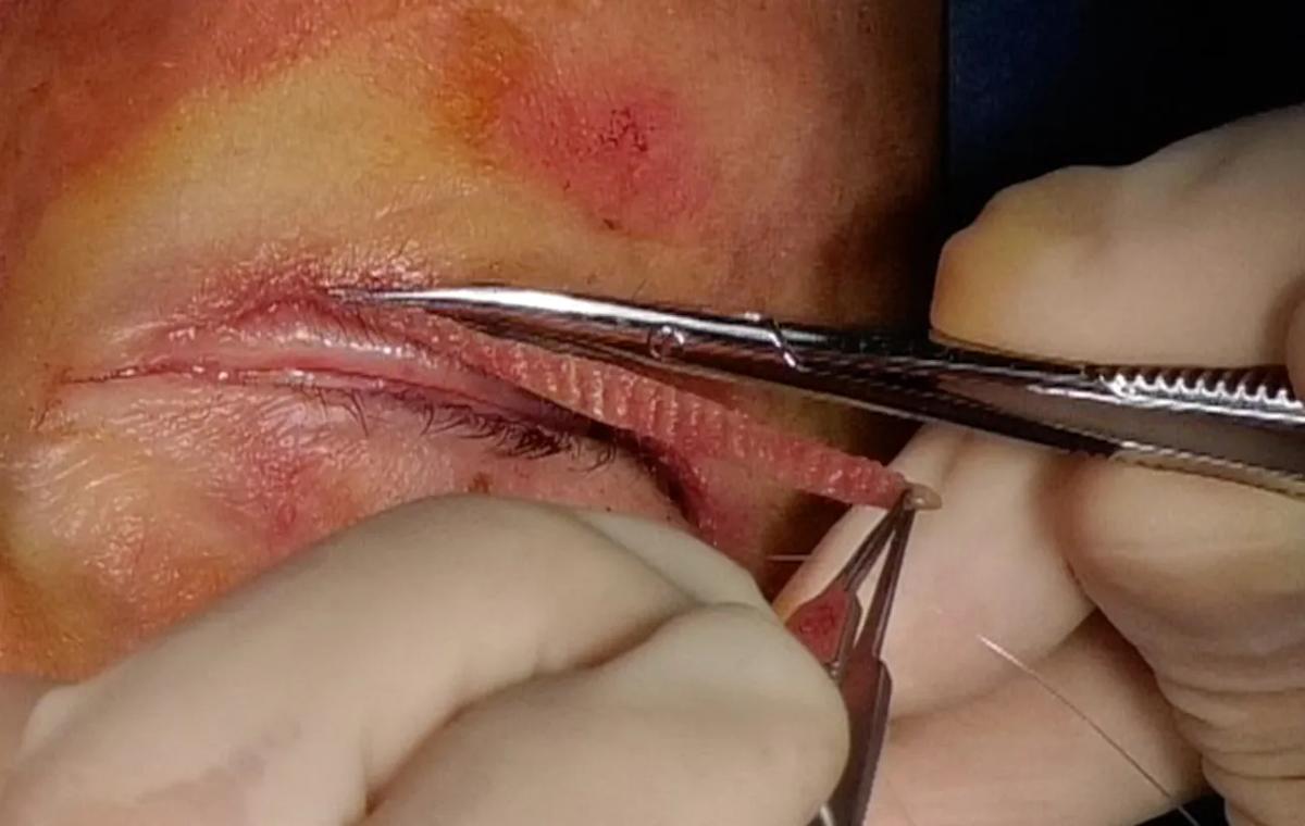 Skin pinch procedure