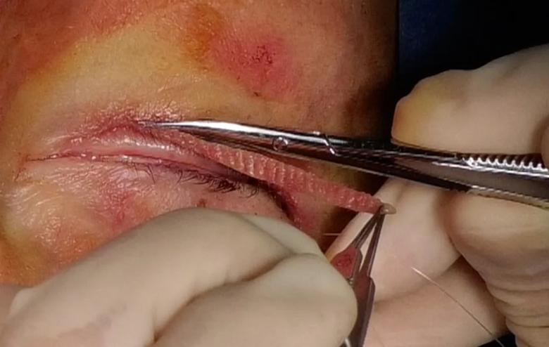 Skin pinch procedure
