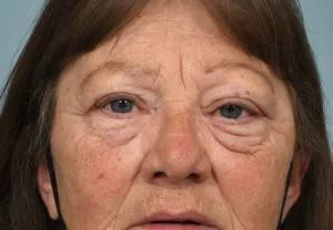 Patient post-op after TONES