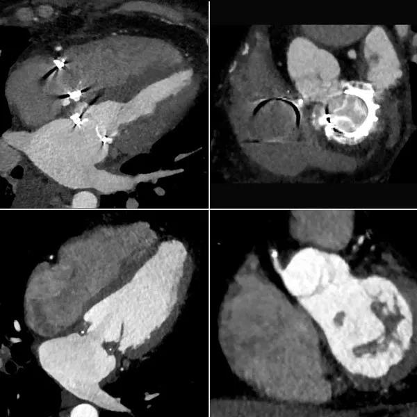 Four-dimensional (4-D) CT images