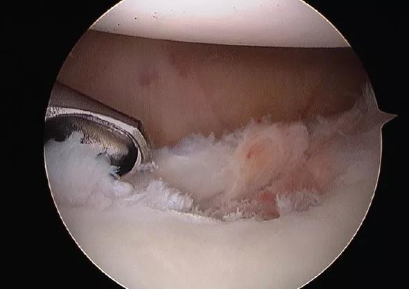 Figure 2. Arthroscopic photo of the debridement of the labral tear from Figure 1.
