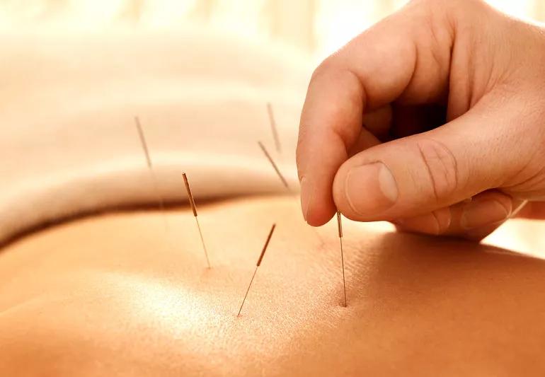 Ivf  Acupuncture, London