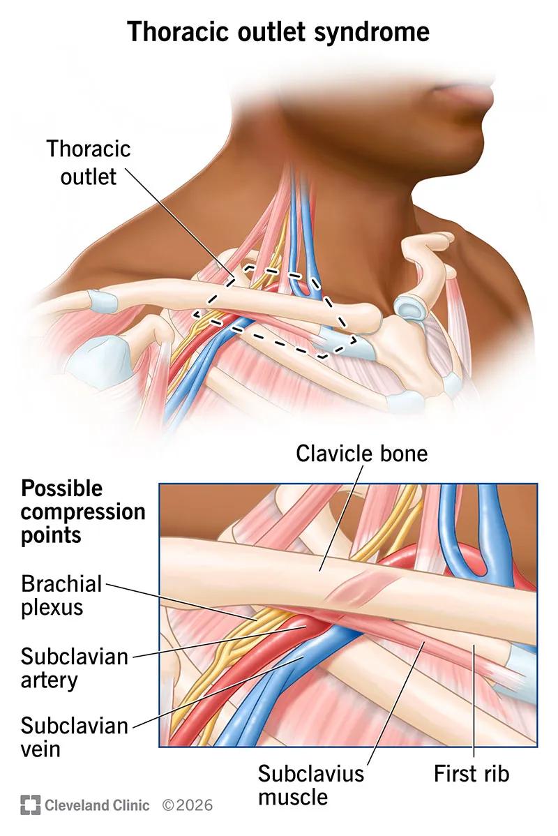 Anatomy of thoracic outlet syndrome, with possible compression points