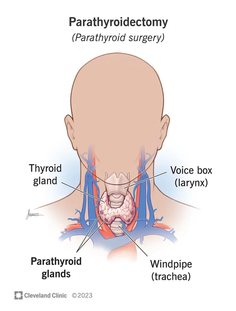 medical illustration of parathyroidectomy