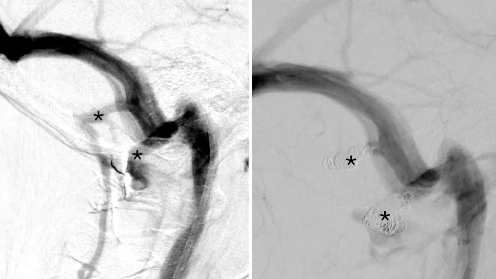 semaglutide and retinal detachment Dose-dependent Risk for Ischemic Optic Neuropathy Found with Semaglutide