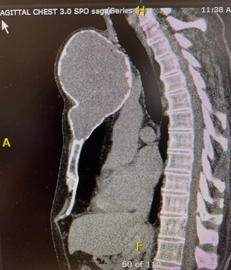 X-ray showing a large ball growing from the sternum