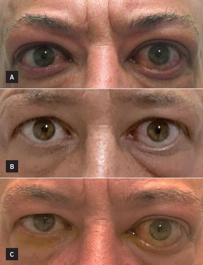 Patient with thyroid eye disease before and after treatment with teprotumumab