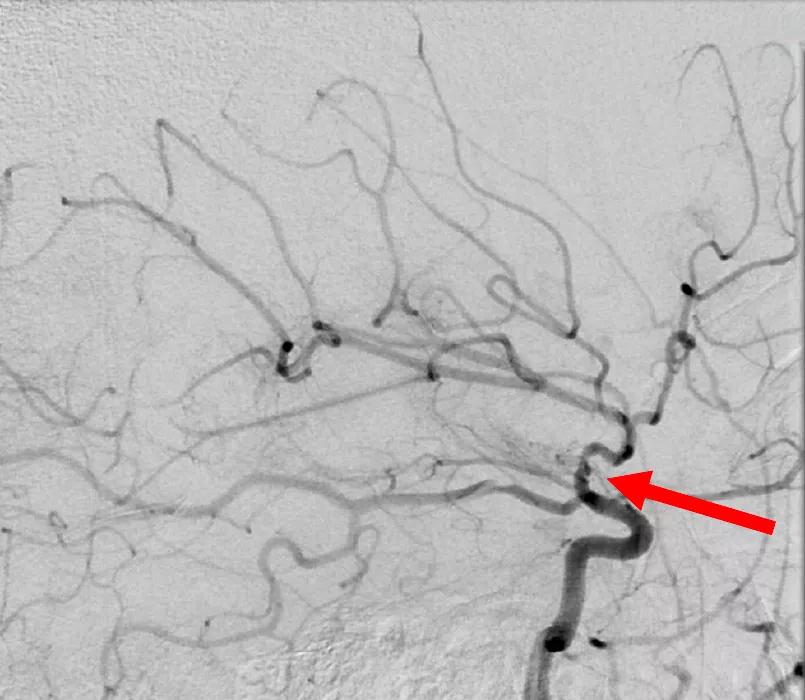 Pediatric Arterial Ischemic Stroke 