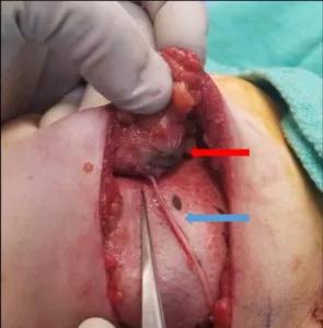 Coaptation of the nerve allograft and nipple-areolar complex.