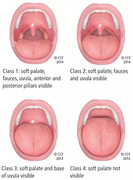 Friedman palate positions