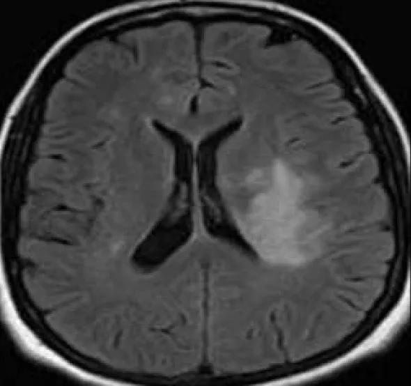 Figure 3. Brain CT two months after presentation shows a large hemorrhage at the left temporooccipital junction with surrounding edema. There is a moderate mass effect on the left lateral ventricle. A small subdural hematoma may be present along the left lateral frontotemporal region. 