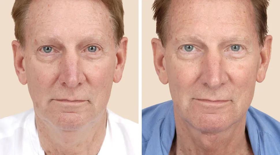 Front View - Before and After