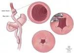 Transoral outlet reduction (TORe)