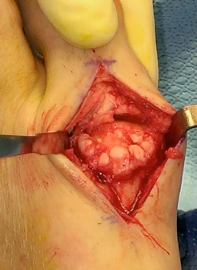 Fig. 1: Dorsal osteophyte formation noted to the first metatarsal head. 