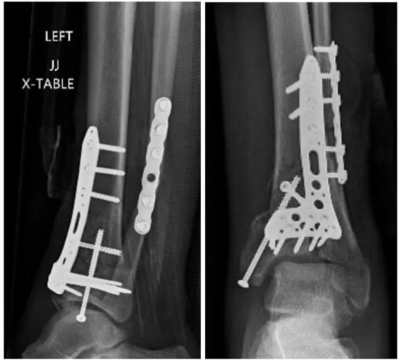 Radiographs demonstrating prior ORIF to the distal tibia with malreduction