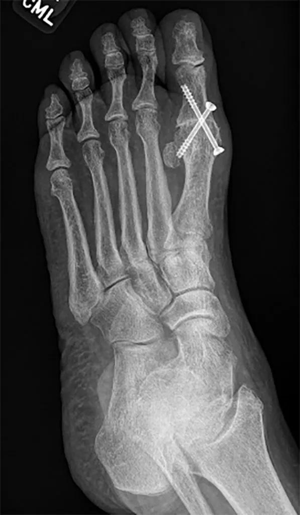 Great Toe Pain: First Metatarsophalangeal Joint Fusion Has