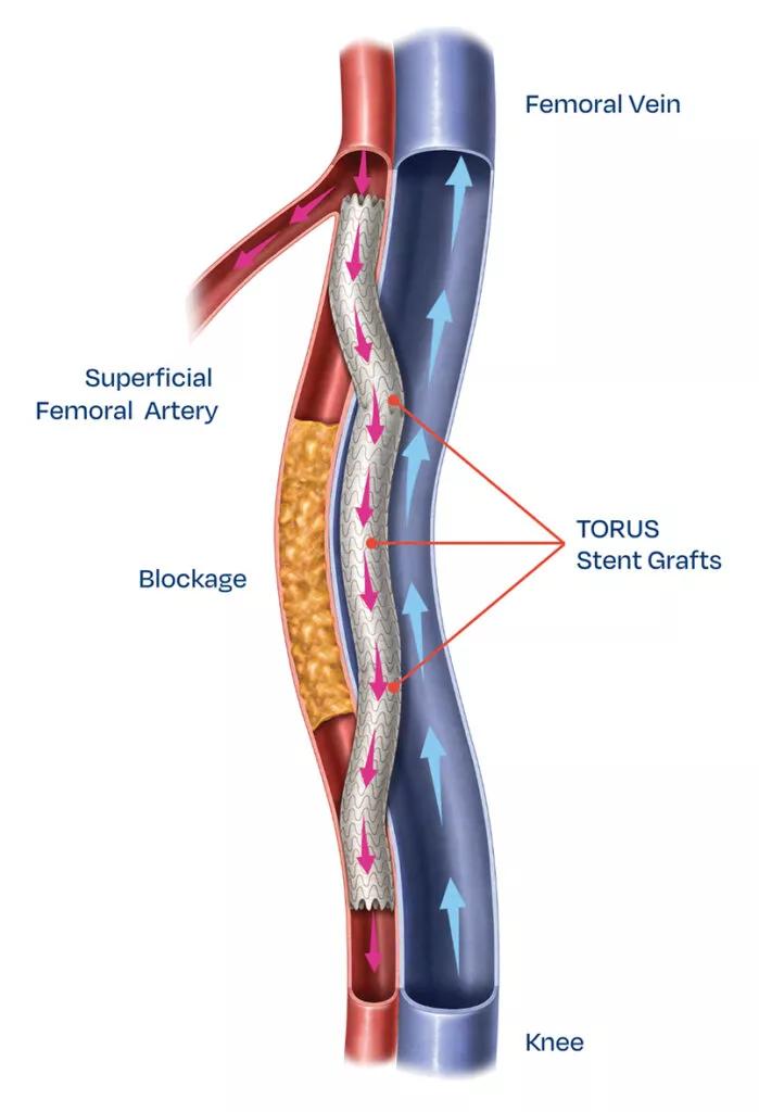 illustration of femoropopliteal bypass with the DETOUR system