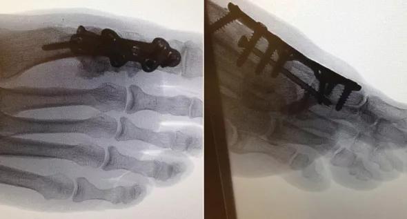 Postoperative anteroposterior and lateral fluoroscopy images of the first MTP joint with the allograft and hardware in place. 