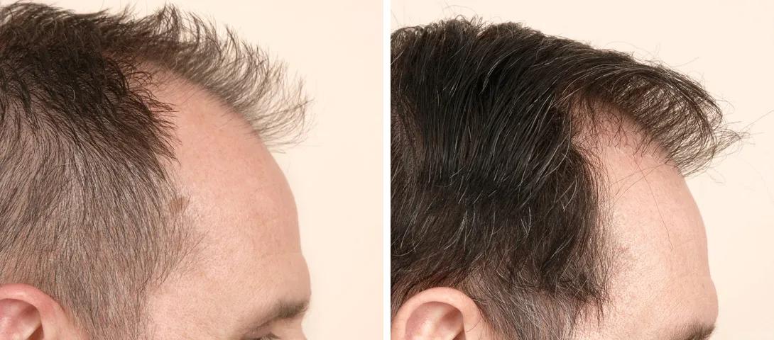 Before and after image of hair replacement surgery from the side