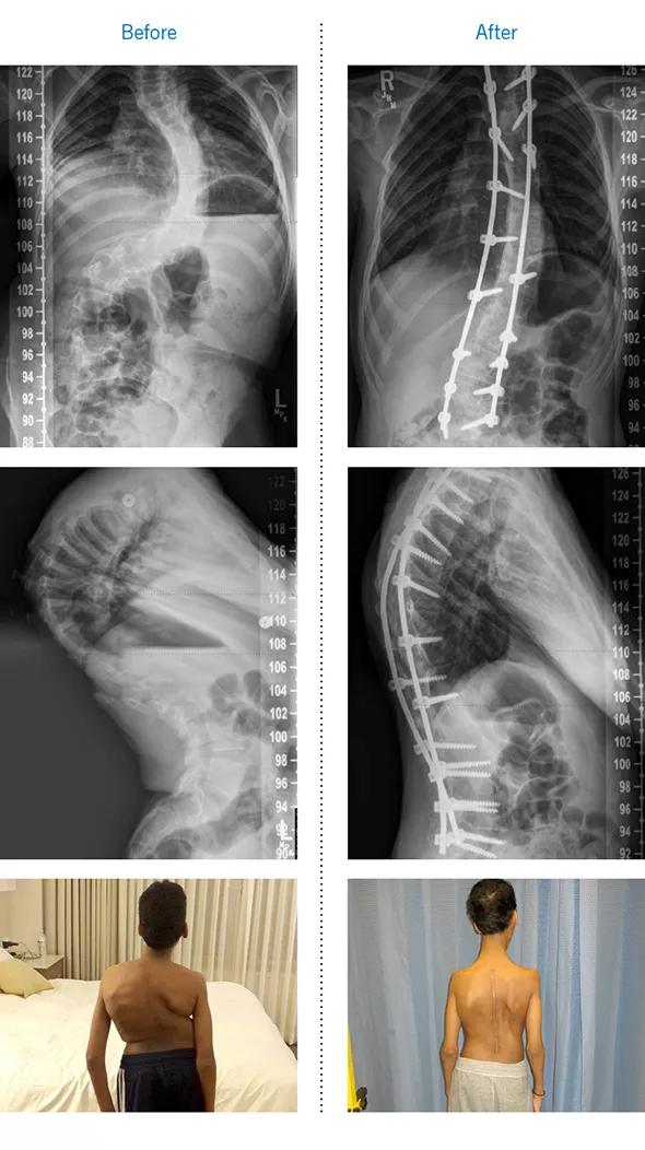 Radiographs and photographs of the case patient at presentation (left) and after spinal fusion and rehabilitation (right). 