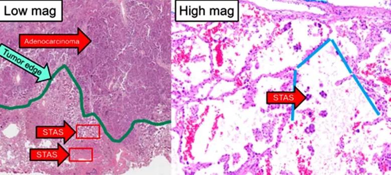 histology images showing spread through air spaces (STAS) in lung cancer