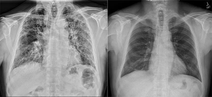 X-rays