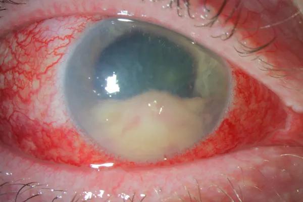 Two weeks after anterior chamber washout.