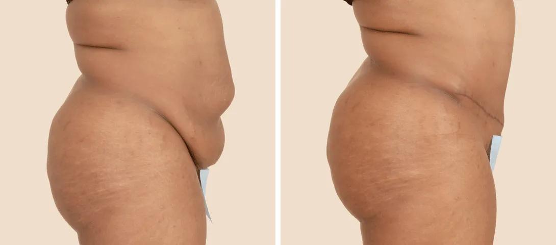 Before abdominoplasty (left) and nearly 3 months after (right).