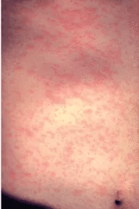 Measles rash