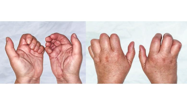 swollen hands