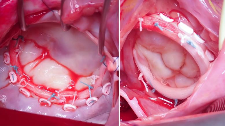 side-by-side photos of heart valves during surgery