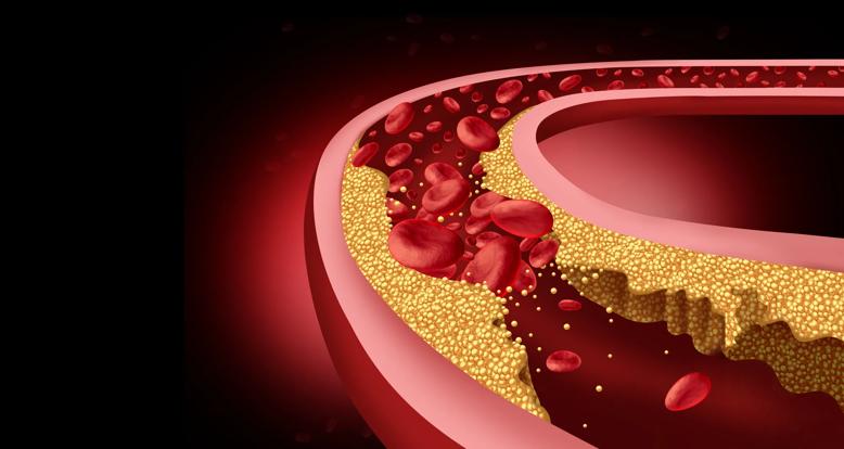 Medical illustration of atherosclerosis.