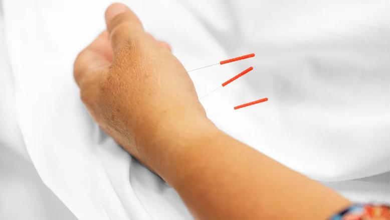 Acupuncture in wrist
