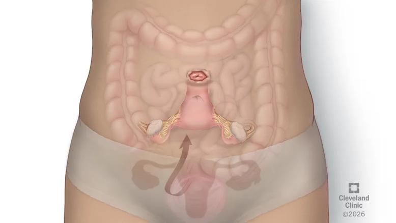 medical illustration of the repositioning of the uterus and cervix during transposition surgery