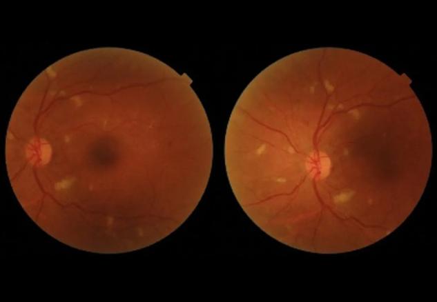 Fundus image of diabetic retinopathy