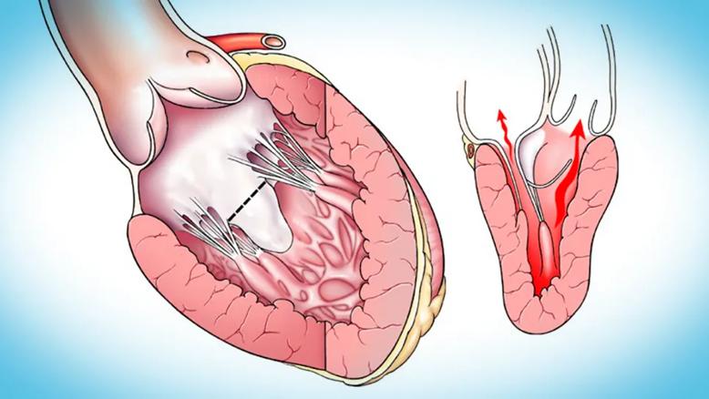 two illustrations of a thickened human heart