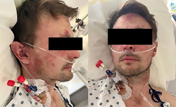 Two clinical images of a man with erythematous patches on his ace and ears.