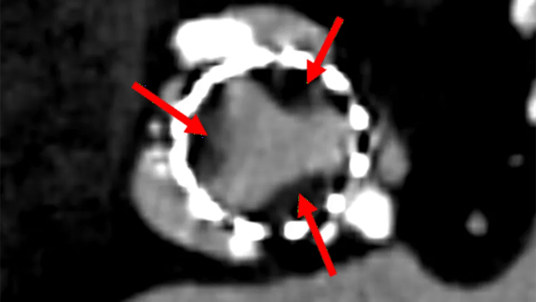 bioprosthetic heart valve with thrombosis seen on imaging study