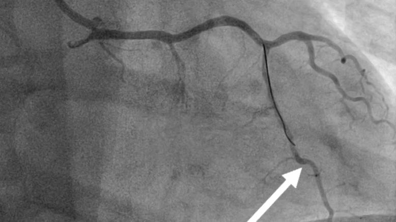 scan of a blood vessel with white pointing arrow