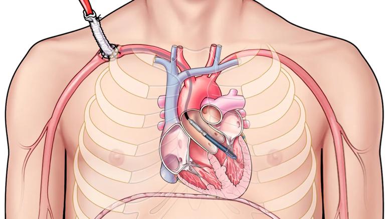 illustration showing device inserted into heart chambers via blood vessels