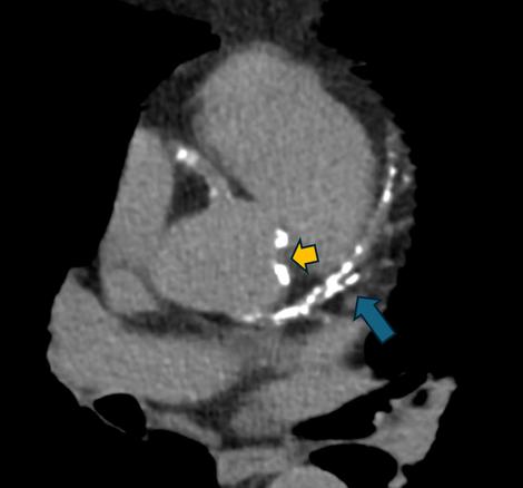 heart scan with blue and yellow arrow overlays